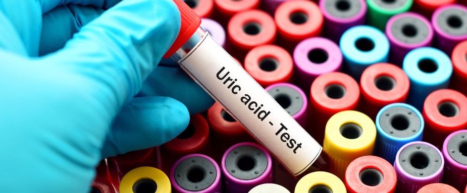 Uric Acid Uric Acid: The Body’s Physiological Alarm Bell?